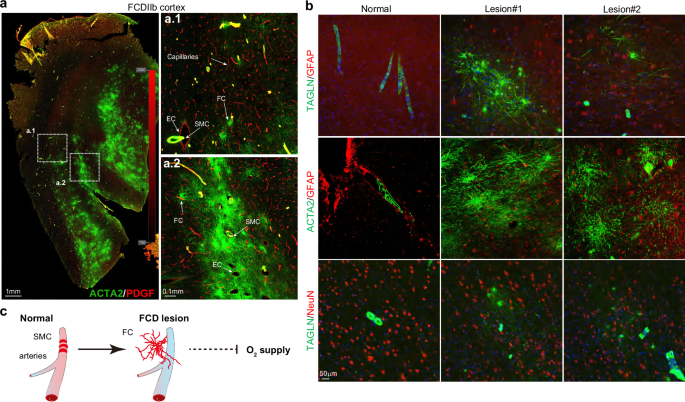 Fig. 3: Firework cell: abnormal SMCs in FCDIIb.