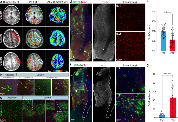 Fig. 4: Local ischemia-hypoxia: the pathogenic contribution of vascular malformation.