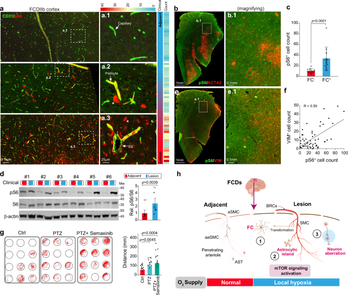 Fig. 5: Vascular malformation contributes to seizure pathogenesis.