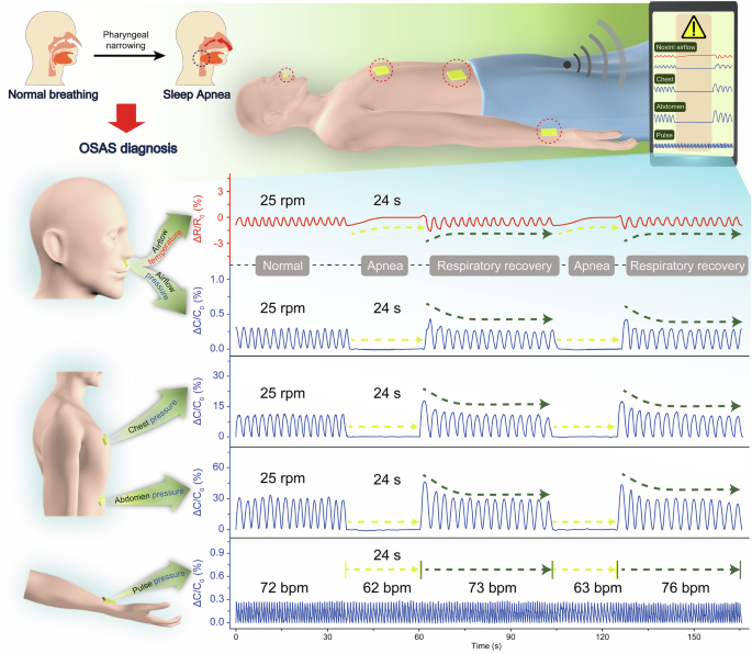 Fig. 9: Monitoring OSAS by ATH6 sensor.