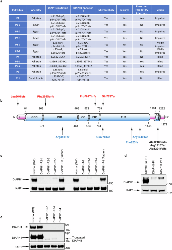 Fig. 1: Loss of DIAPH1 is associated with microcephaly, seizures, recurrent respiratory infections and visual impairment.