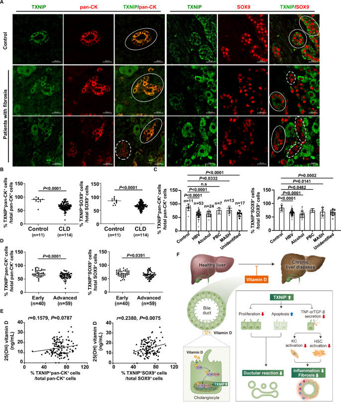 Fig. 8: Correlation between biliary TXNIP expression and vitamin D levels in patients with CLDs.