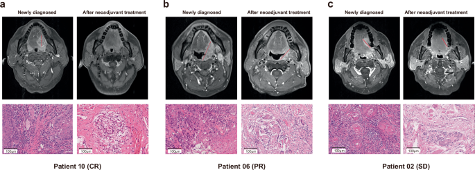 Fig. 4: Magnetic resonance images (T1 enhanced sequence images) and H&E staining images (20×) of primary site tumor before and after two courses of neoadjuvant therapy.
