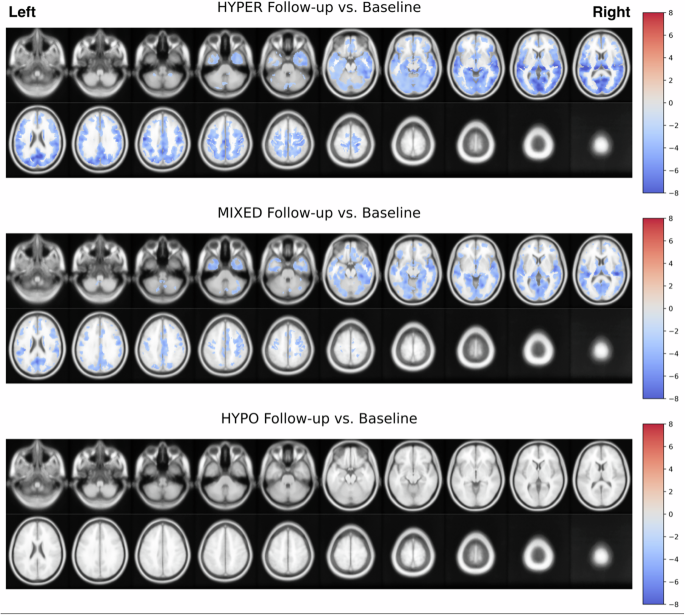 Fig. 3: Main voxel-based SPM analysis comparing each subgroup within-subject at follow-up visits relative to baseline visits with paired samples t tests (adjusted for days between visits, age, and scanner).