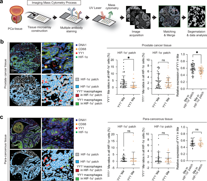 Fig. 1: YY1+ macrophages accumulate in hypoxic tumor tissues.