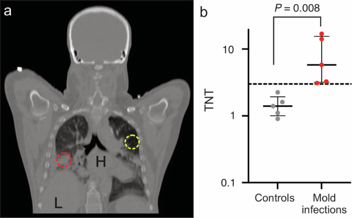 Fig. 2: Quantification of 18F-FDS PET signal in patients with mold infections.