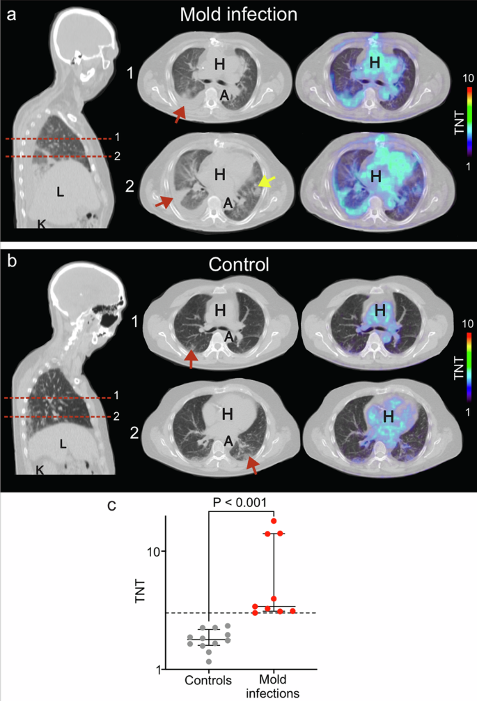 Fig. 3: Thoracic 18F-FDS PET/CT imaging in patients.