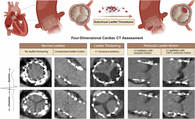 Fig. 4: Subclinical Leaflet Thrombosis.