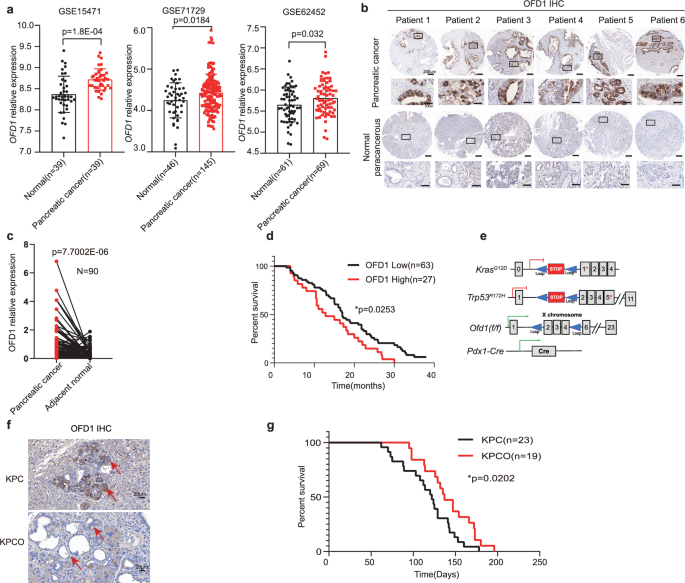 Fig. 1: Overexpression of OFD1 in pancreatic cancer correlates with poor prognosis.