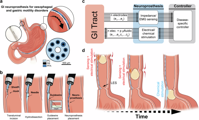 Fig. 1: Closed-loop gastrointestinal neuroprosthesis and minimally invasive submucosal implantation tool.