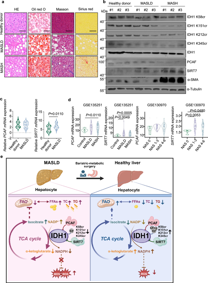 Fig. 10: The PCAF/SIRT7-mediatded IDH1 Kcr exhibits progressive suppression in parallel with advancement of MASLD.