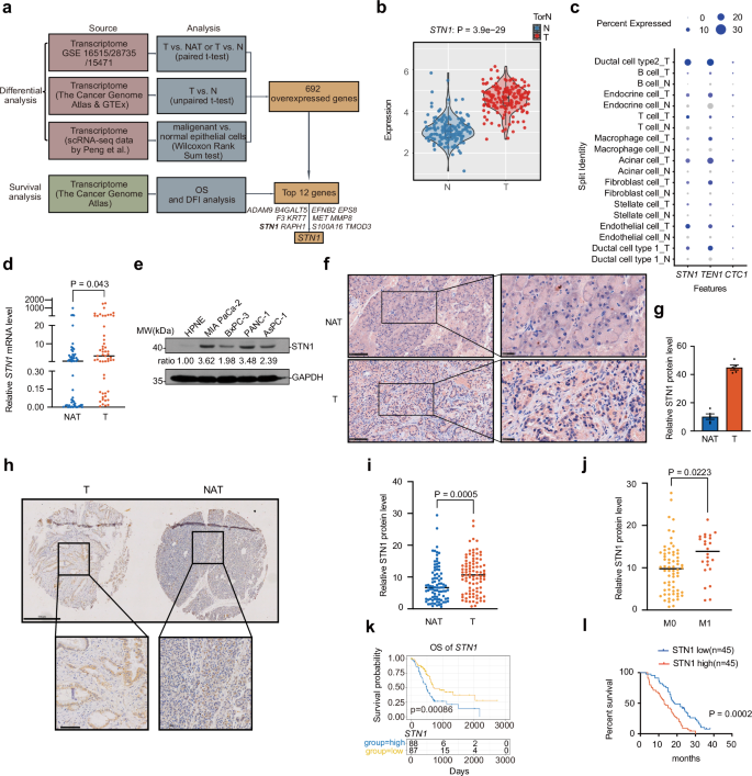 Fig. 1: Elevated STN1 expression is associated with adverse survival outcomes in PDAC patients.