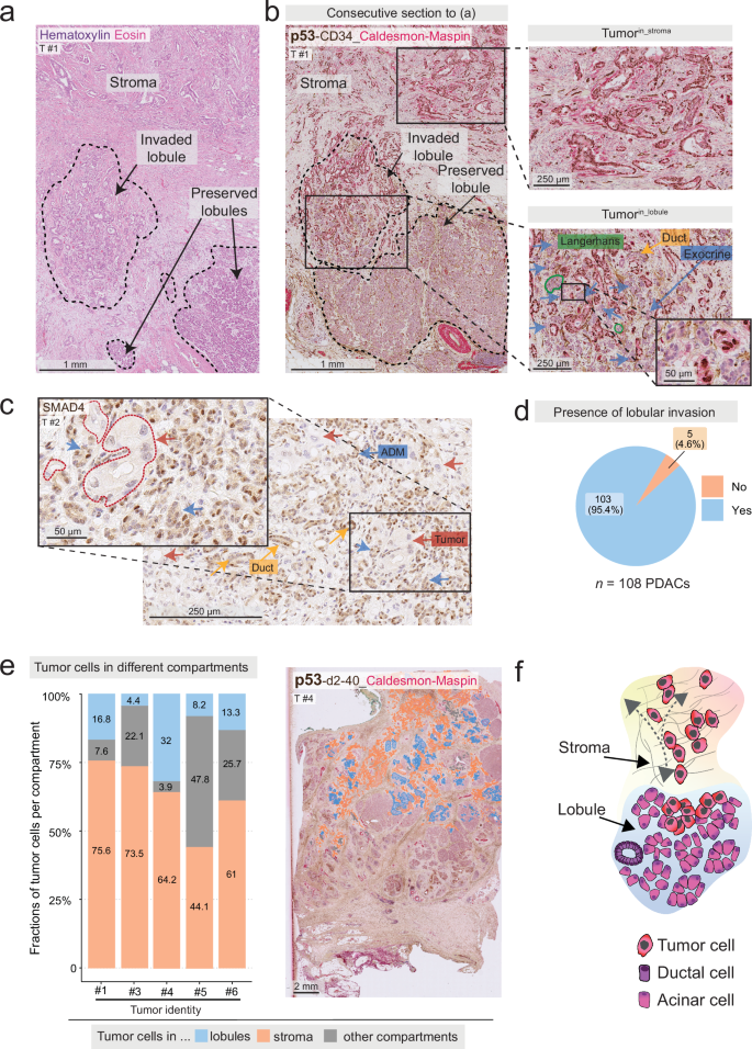 Fig. 1: Pancreatic ductal adenocarcinoma colonizes the pancreatic lobules.