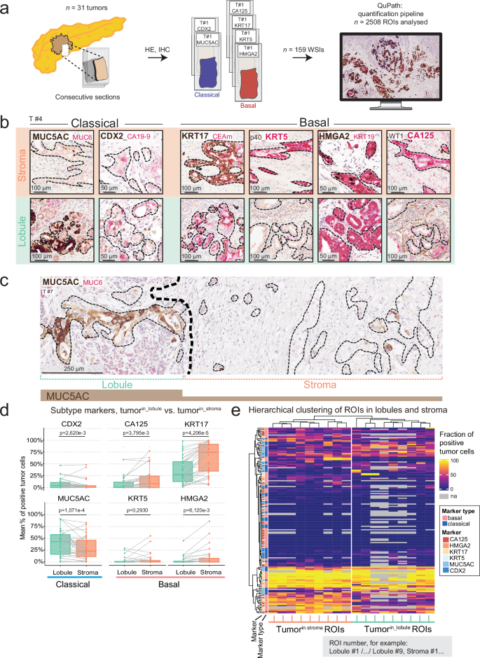 Fig. 2: Pancreatic tissue compartments drive PDAC subtype identity.