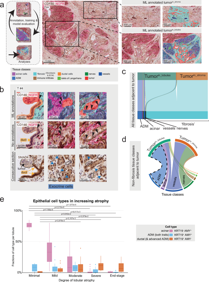 Fig. 3: PDAC tumor cells in direct proximity to non-malignant epithelial cells at the lobular invasion front.
