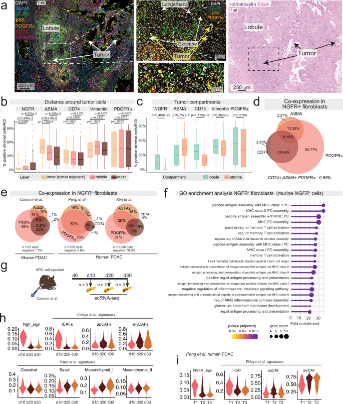 Fig. 5: NGFR+ /PDGFRα+ cells are linked to lobular invasion and an inflammatory microenvironment.