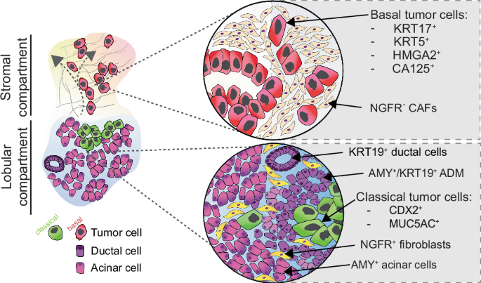 Fig. 7: PDAC invasion into an injured lobular microenvironment is linked to a shift towards classical tumor phenotypes.