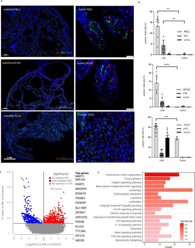 Fig. 2: Senescence in LAM nodules.