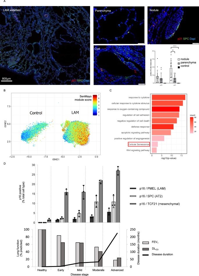 Fig. 3: AT2 cells are senescent in LAM.