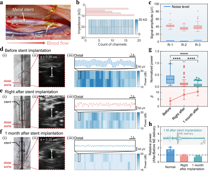 Fig. 3: Stent-induced vasomotor dysfunction monitoring.