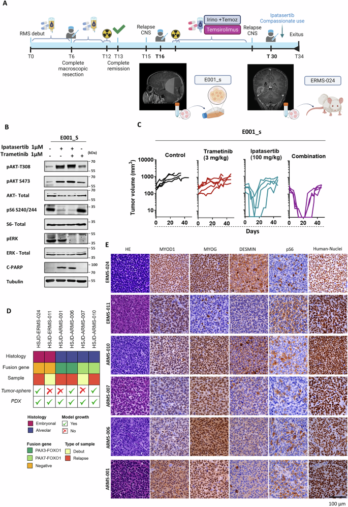 Fig. 1: First-in-Human Experience of ipatasertib in RMS: Clinical Course, Sample Collection, and Analysis.