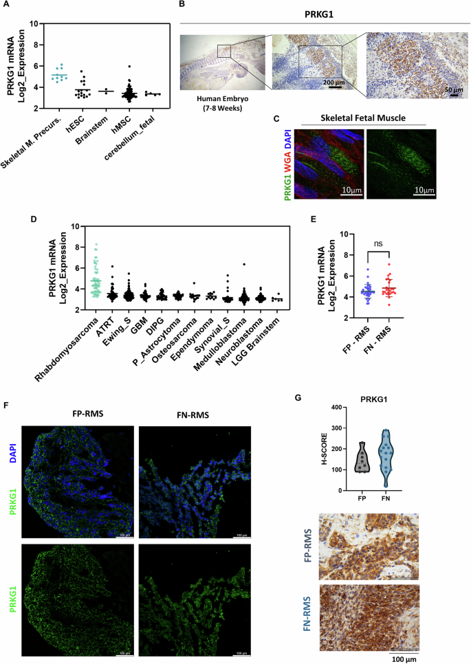 Fig. 6: PRKG1 is expressed in fetal tissues and in RMS samples.
