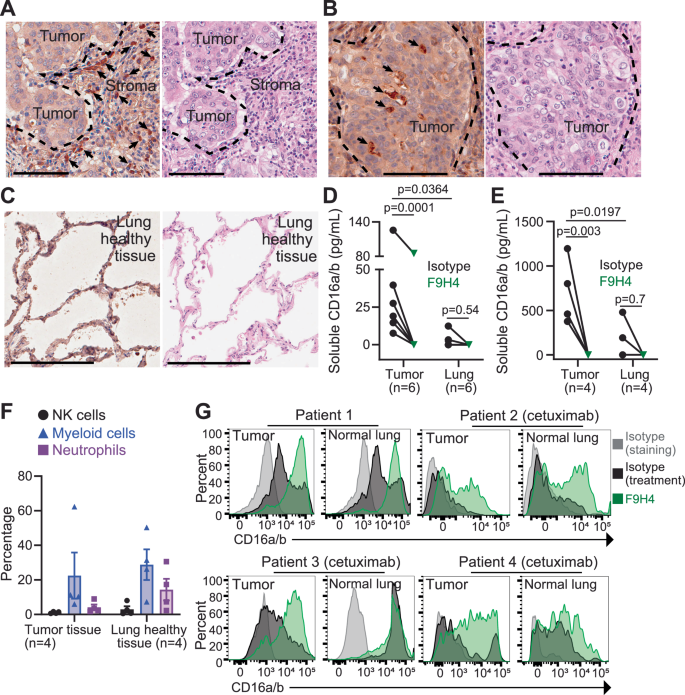 Fig. 6: F9H4 inhibits the CD16a/b shedding by tumor-infiltrating leukocytes from untreated patients with early-stage NSCLC.