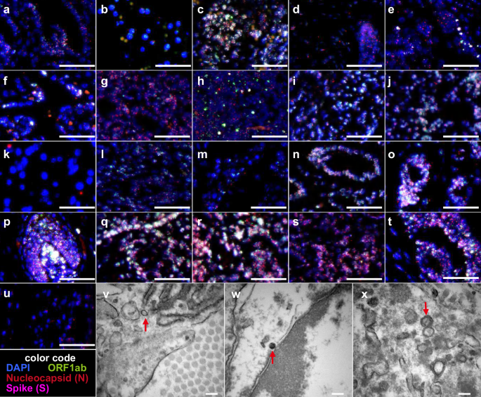 Fig. 2: RNAscope and TEM of SARS-CoV-2 virus in fetal organs.