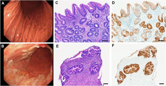 Fig. 1: Erosive gastritis after zolbetuximab.