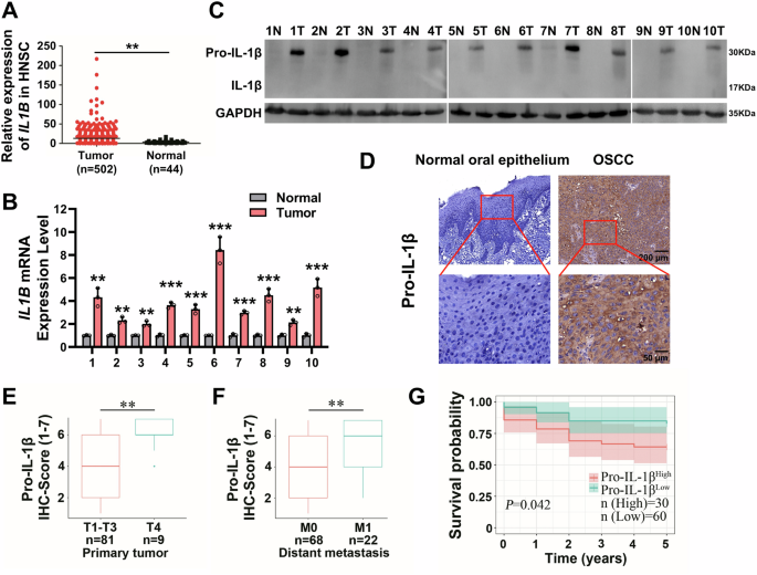 Fig. 1: High expression of Pro-IL-1β associates with metastasis and unfavorable prognosis in HNSCC patients.