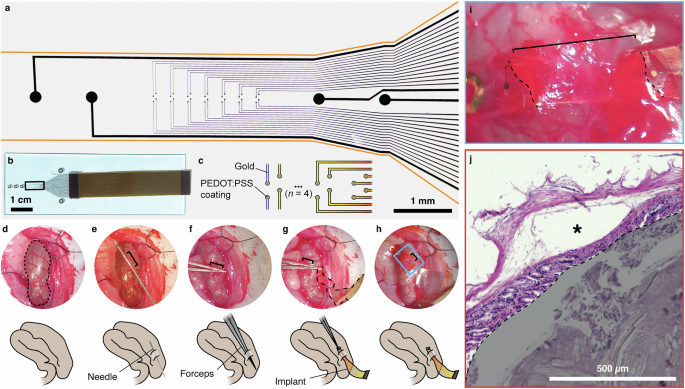 Fig. 1: Conformable devices can be surgically implanted on top of the submucosal plexus of the colon.