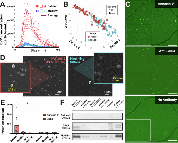 Fig. 2: Isolation and characterization of tumor-derived EVPs from GBM patients’ plasma using GlioExoChip.