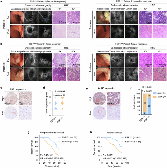 Fig. 1: Elevated FSP1 expression is correlated with unfavorable chemotherapy response and patient outcomes.