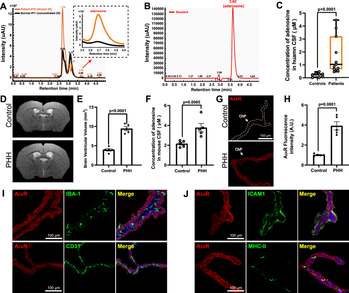 Fig. 1: Aberrant adenosine signaling during hydrocephalus in the cerebrospinal fluid (CSF) and choroid plexus (ChP).