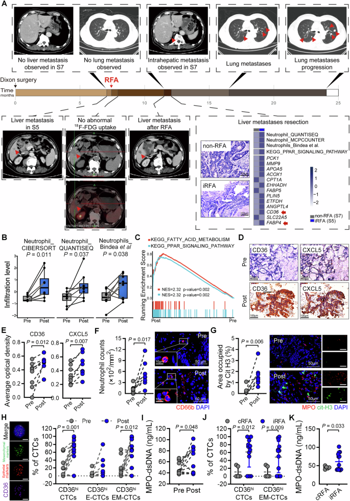 Fig. 8: CD36hi-EM-CTC detection assists in the early identification of iRFA.