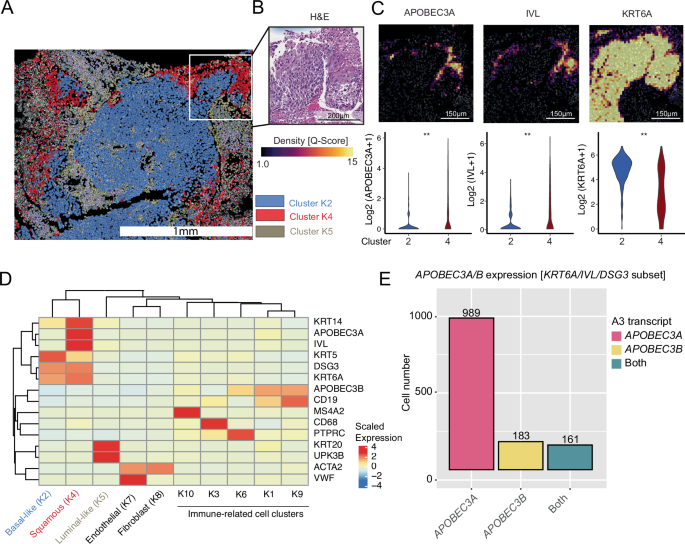 Fig. 7: Human APOBEC3A is spatially coexpressed with urothelial carcinoma cells with squamous differentiation.