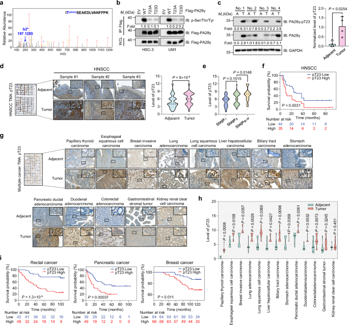 Fig. 1: The phosphorylation level of PA28γ at T23 is highly expressed in various cancers and is associated with AJCC stage and patient prognosis.