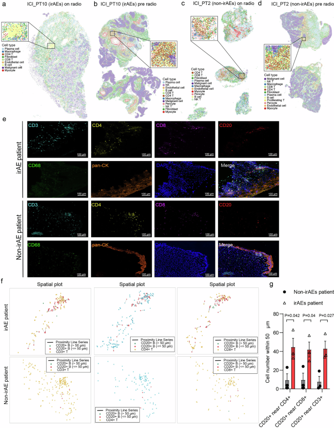 Fig. 6: Xenium data reveal irAE-associated immune cell localization in the TME after chemoradiotherapy.