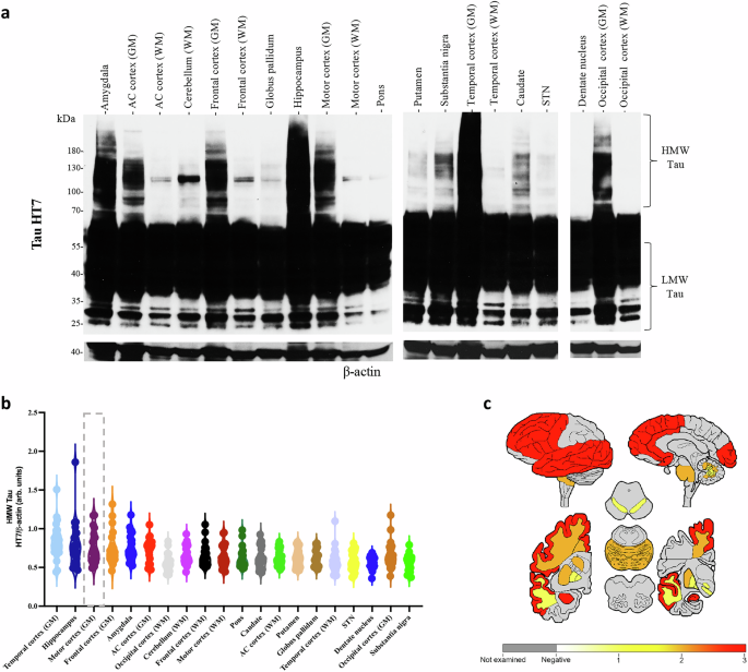 Fig. 1: Quantification of high-molecular-weight (HMW) tau reveals regional heterogeneity in PSP brains.