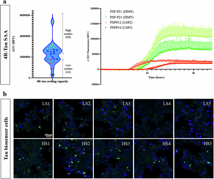 Fig. 2: Variability in tau seeding activity in the primary motor cortex among PSP patients.