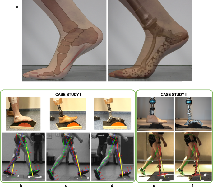 Fig. 3: Parallelism between the human foot and artificial feet.