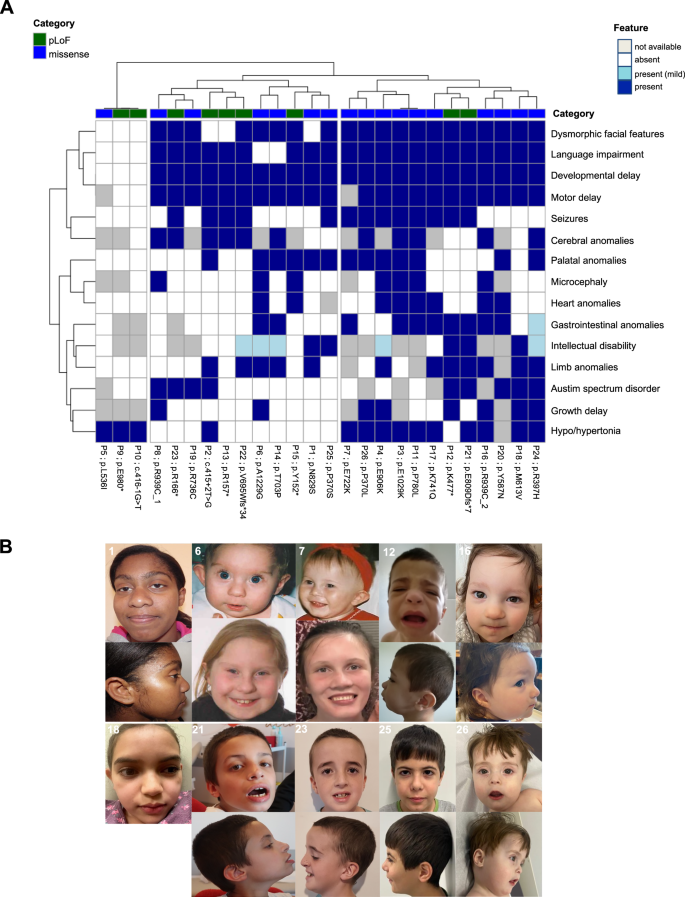 Fig. 1: Individuals carrying predicted loss-of-function (pLoF) and missense variants of SF3B1 present with a neurodevelopmental syndrome.