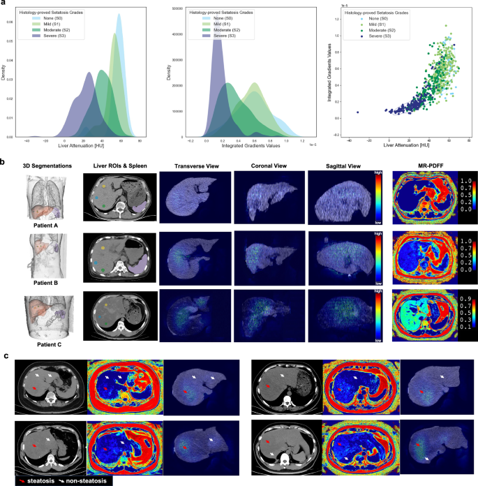 Fig. 4: Visualization and interpretation of MAOSS saliency (integrated gradients) for grading steatosis on NCCTs.