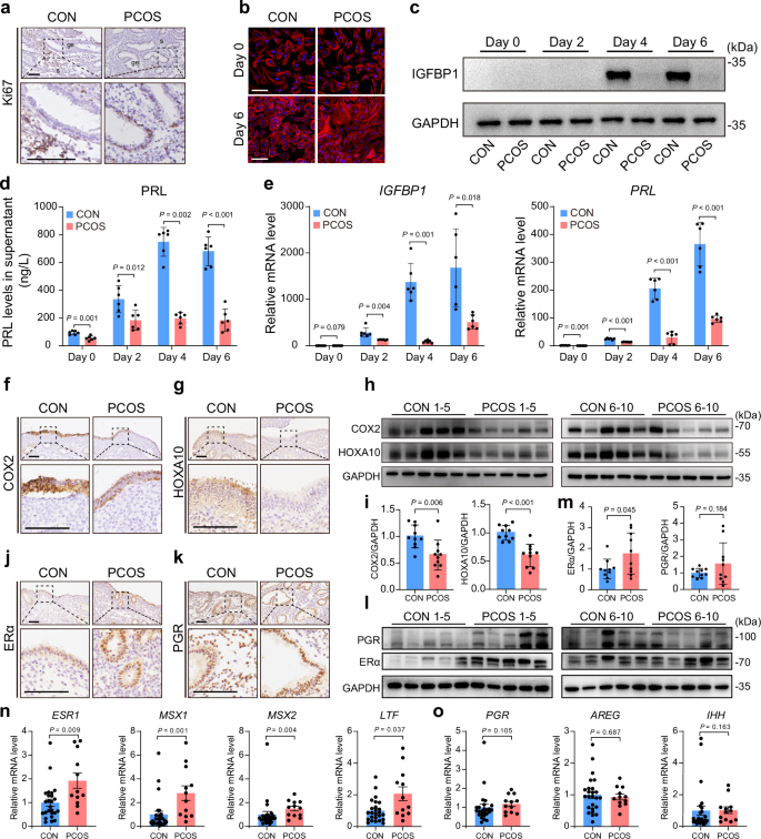 Fig. 1: PCOS endometrium has abnormal endometrial receptivity and ERα expression.