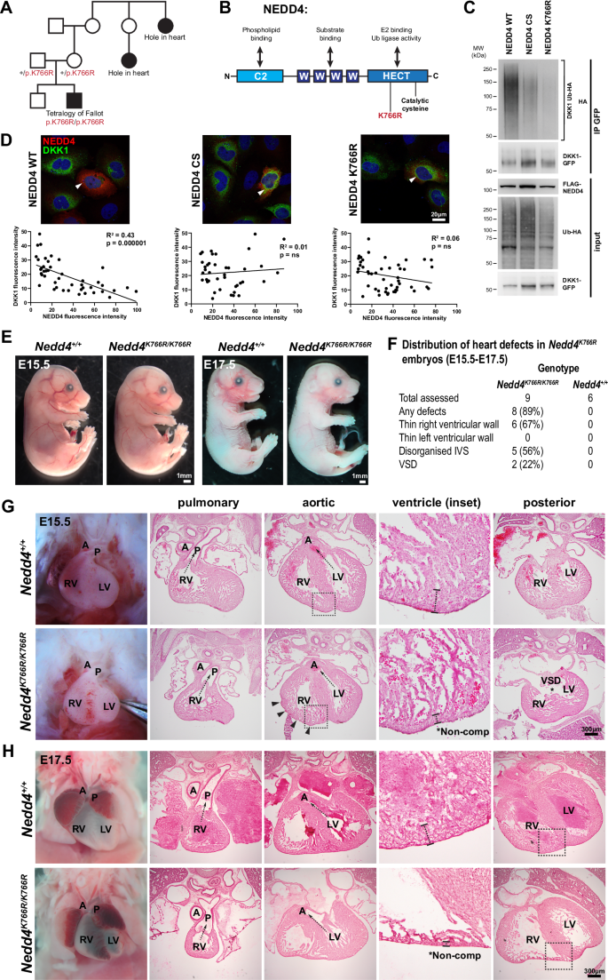 Fig. 7: A NEDD4 variant identified in an individual with congenital heart disease has impaired ubiquitination of DKK1.
