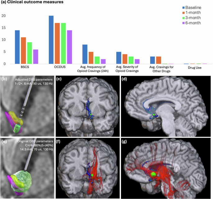 Fig. 2: Optimized NAc stimulation resulted in sustained clinical outcomes, with lower charge requirement.