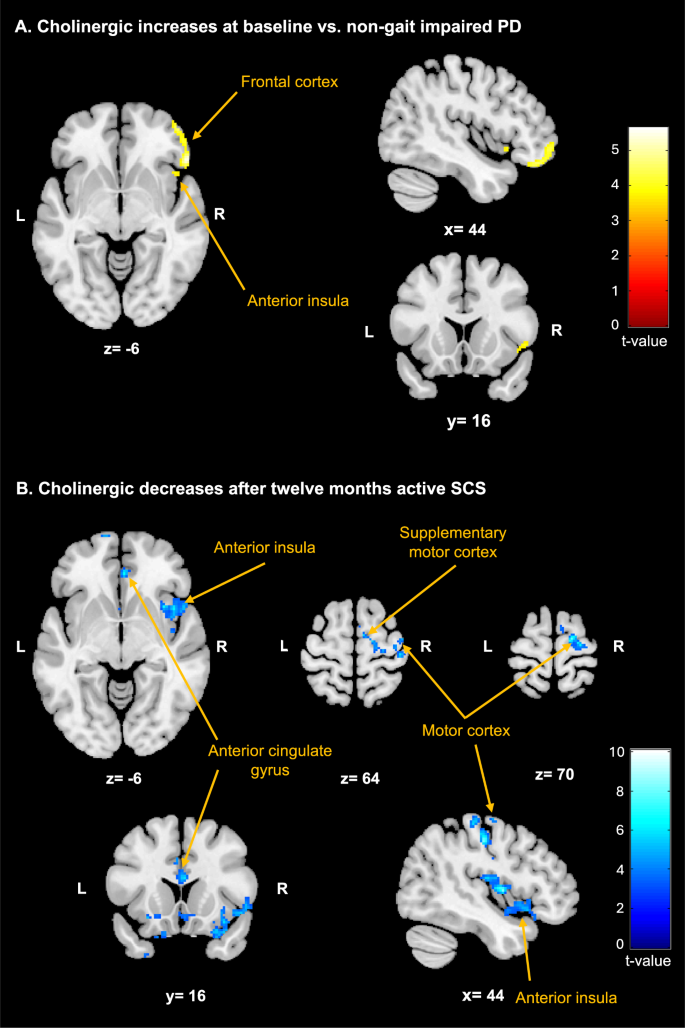 Fig. 3: Cholinergic changes.