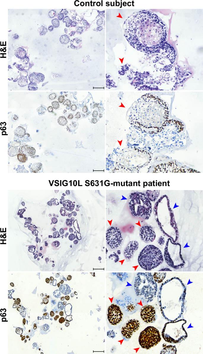 Fig. 2: Impaired SQ maturation and architecture of esophageal organoids derived from VSIG10L-mutant patient.