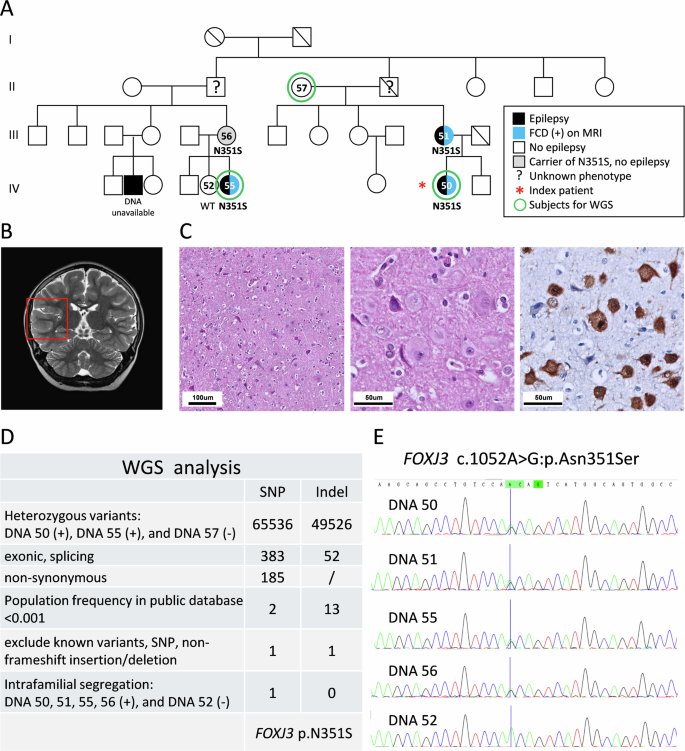 Fig. 1: Genetic and pedigree analysis of a family with focal epilepsy and focal cortical dysplasia associated with a novel FOXJ3 variant.