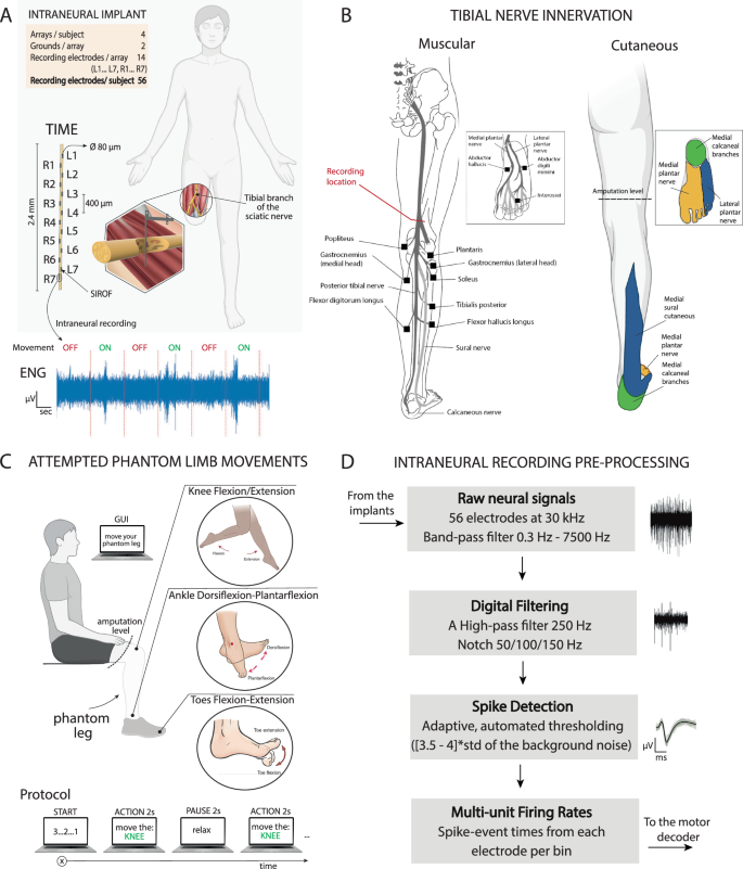 Fig. 1: Intraneural recording of the tibial nerve during phantom movements.